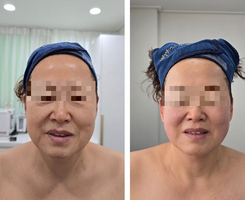 얼굴 관리 전후 비교 사진