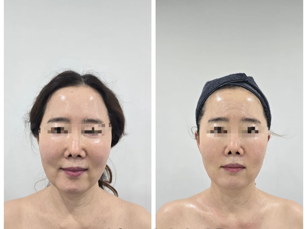 얼굴 관리 전후 비교 사진