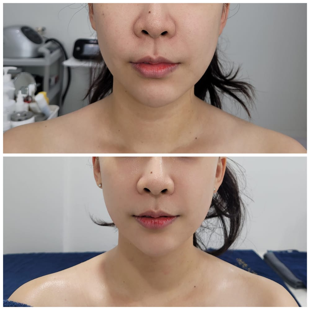 얼굴 관리 전후 비교 사진
